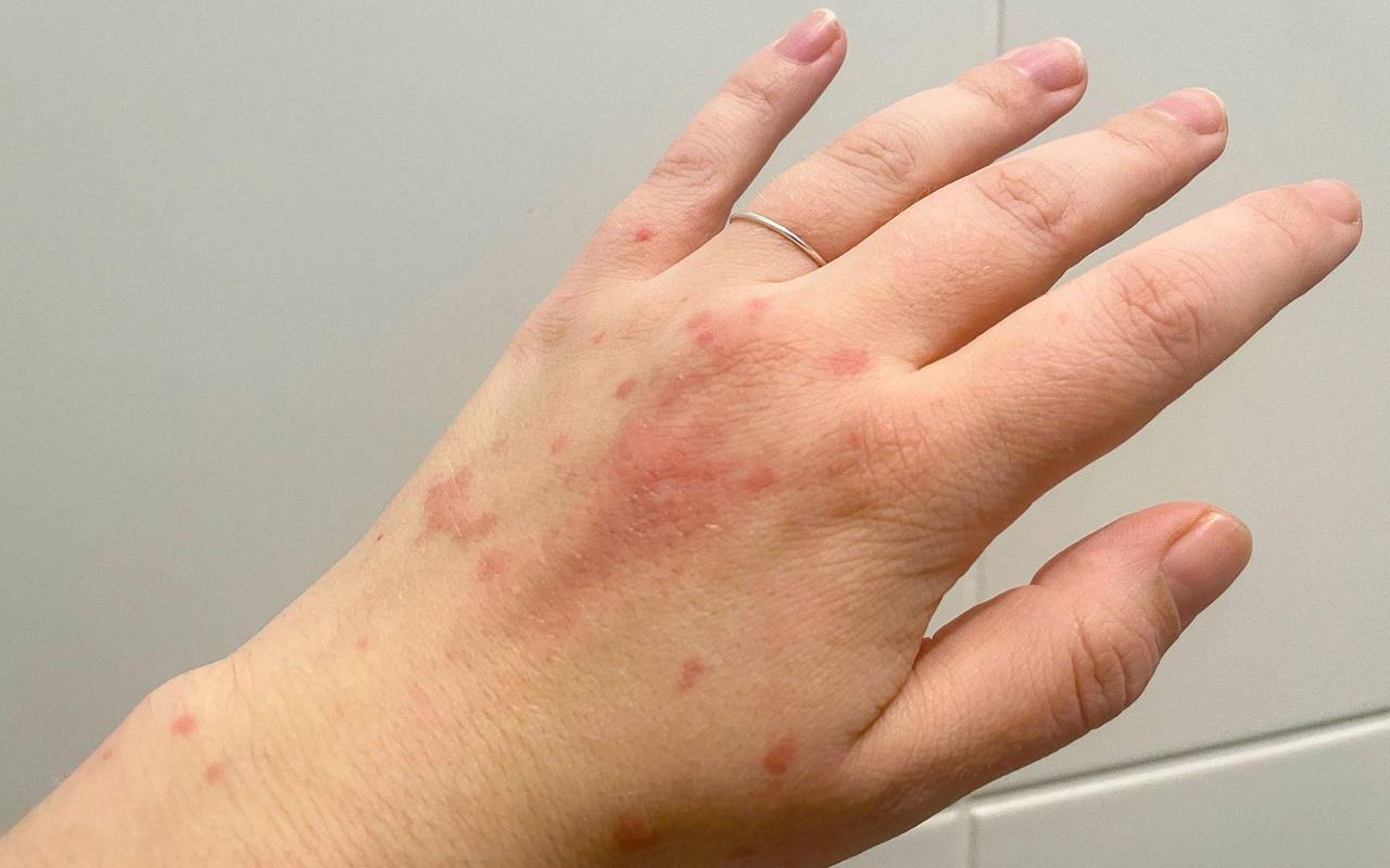 Ein Nesselsucht Ausschlag auf der hand einer Frau