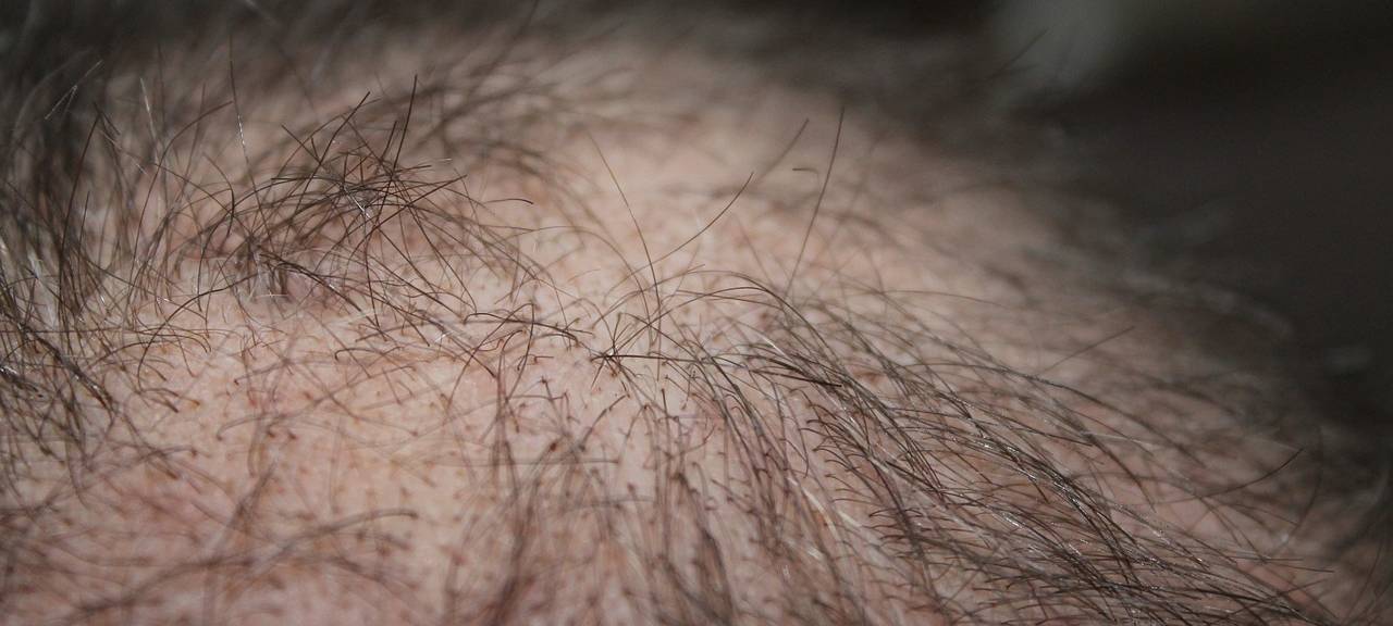 Besonderes Verfahren gegen Haarausfall
